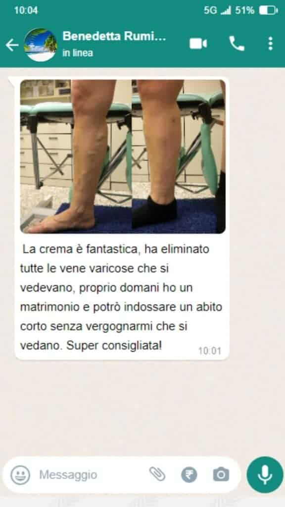 Trattamento varicosi con crema sulle gambe.
