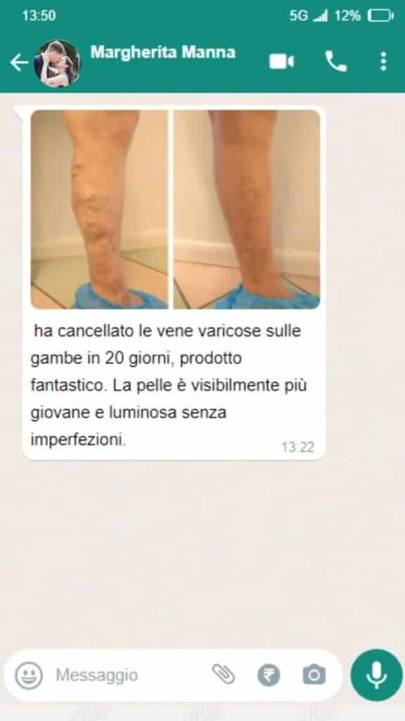 Prima e dopo il trattamento varico sulle gambe.