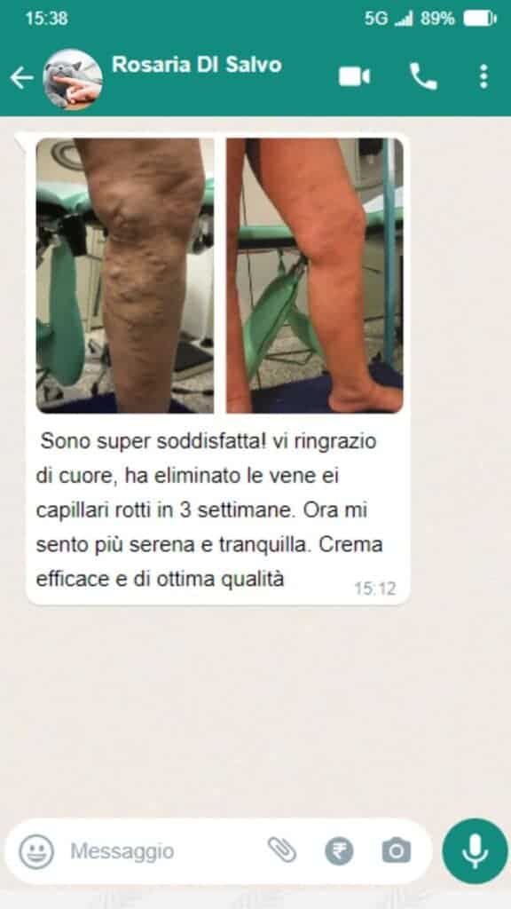 Prima e dopo il trattamento delle vene con Varico lift 2x1.