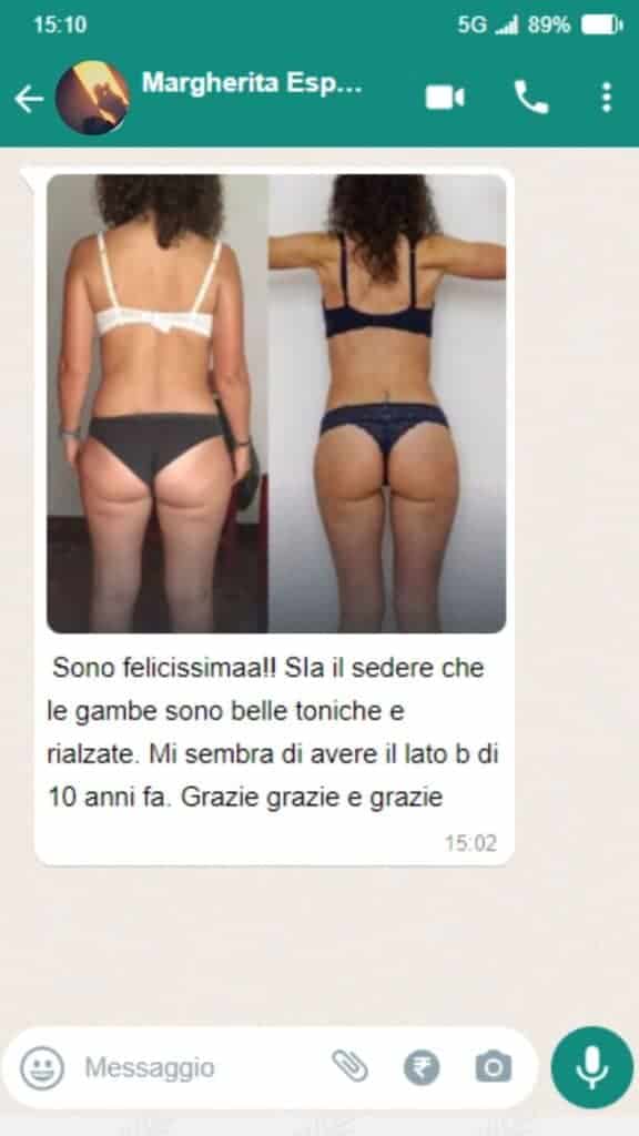 Prima e dopo il trattamento Spiru Lipo 1x per la perdita di peso.