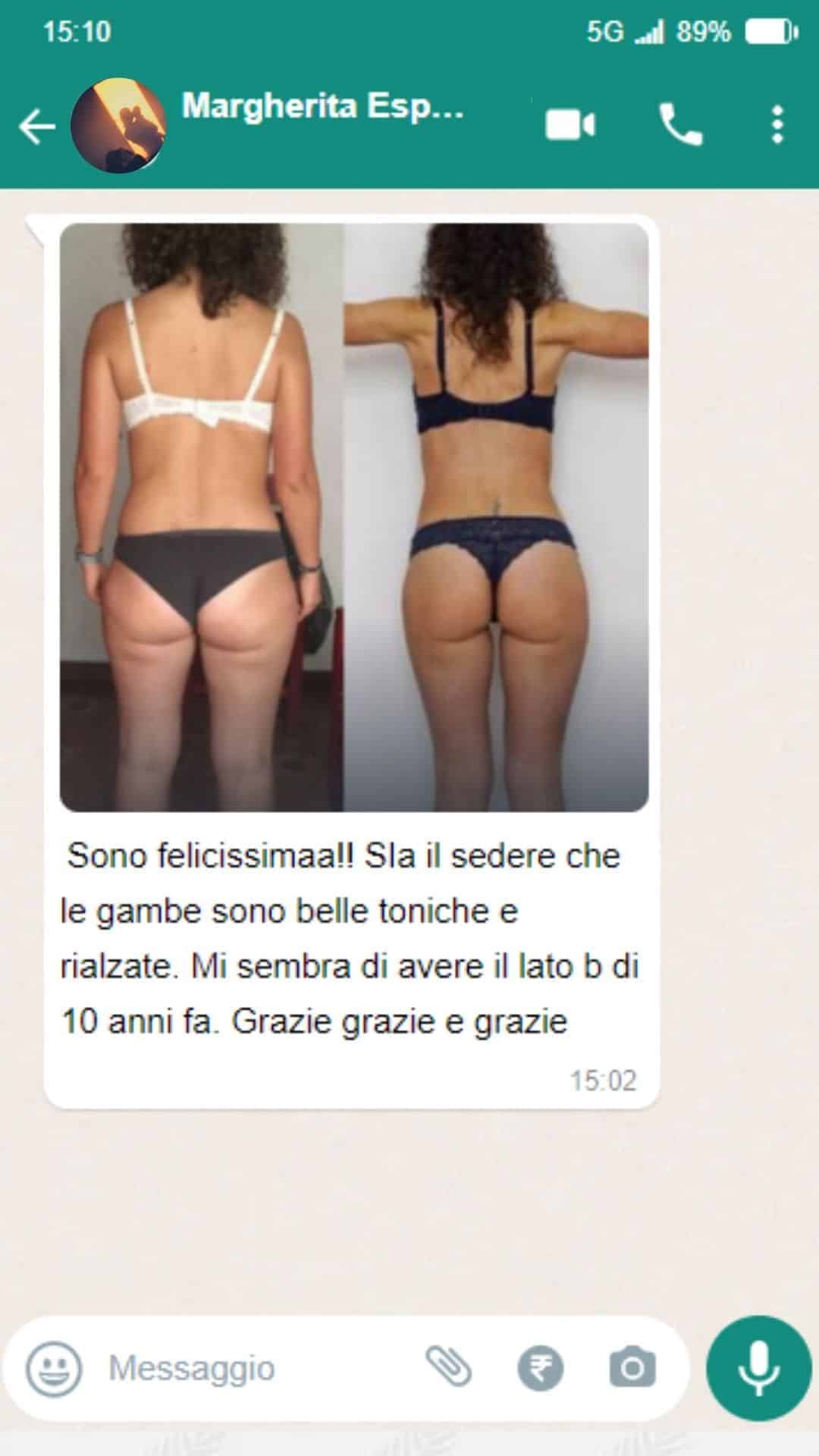 Prima e dopo il trattamento Spiru Lipo 1x per la perdita di peso.